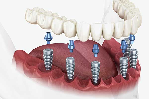 Implants dentaires Turquie