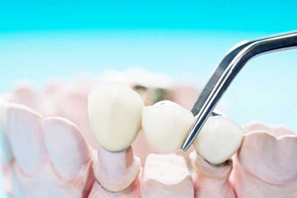 Tarifs des dentistes en Turquie