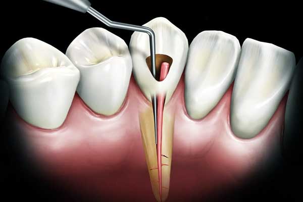 Traitement de canal (endodontie)