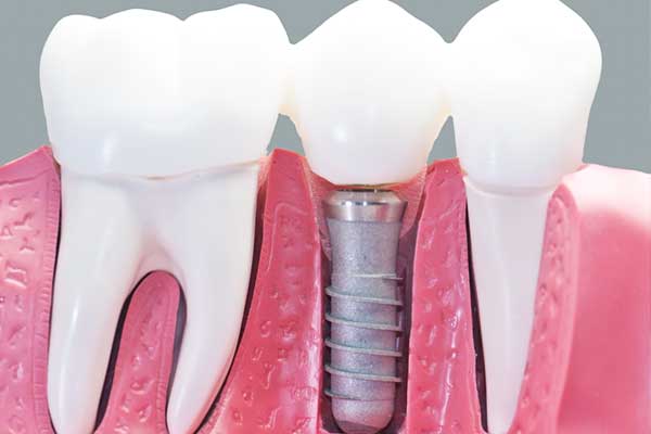 dentition turquie