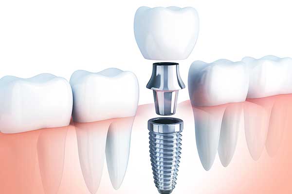 implant dentaire turquie prix