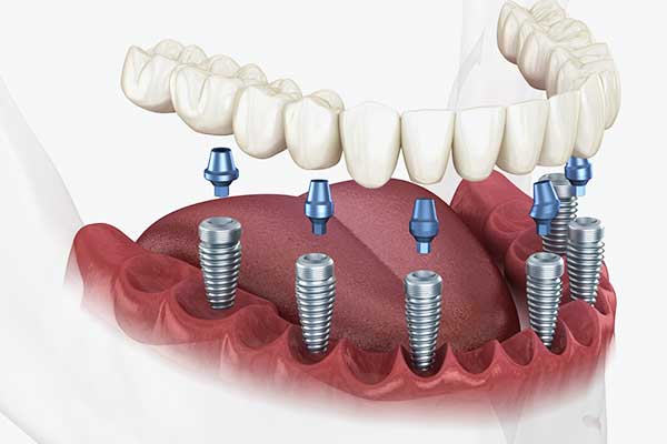 implant ,dentaire ,turquie