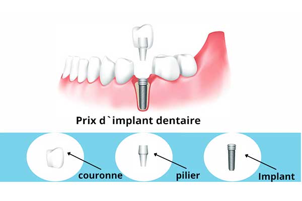 prix dentition turquie