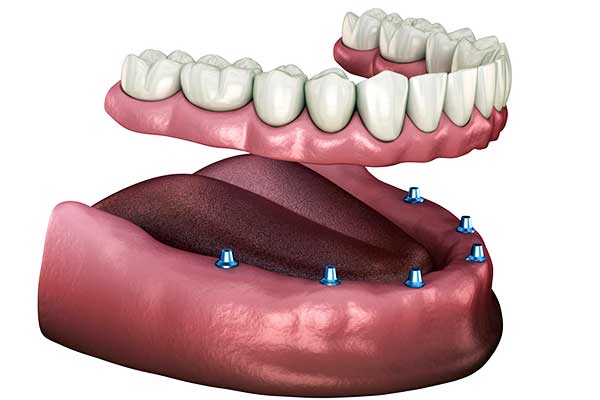 prix implant dentaire mâchoire complète turquie