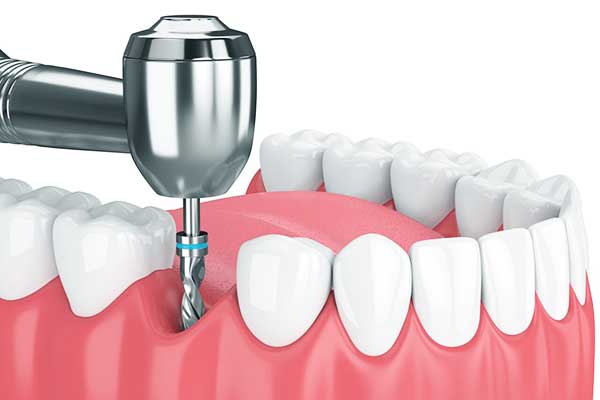 refaire ses dents en turquie